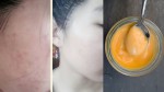 1 tuần dùng công thức này, mụn nào cũng bị xóa sổ hoàn toàn