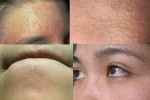 Thổi bay mụn "ẩn dật" trên mặt chỉ với 1 lần đắp công thức mặt nạ dưới đây