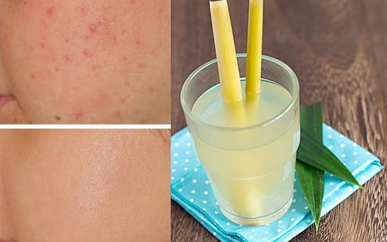 Hướng dẫn cách xông mặt trị mụn bằng chanh, sả hiệu quả nhất