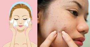 Sai lầm khi rửa mặt khiến da càng ngày càng đen sạm, mụn nhọt