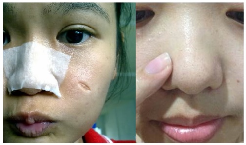 Đắp miếng bông ướt này lên mũi, bạn sẽ không thể tin vào kết quả cuối cùng