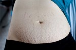 Cách trị rạn da thân thiện cho mẹ bầu