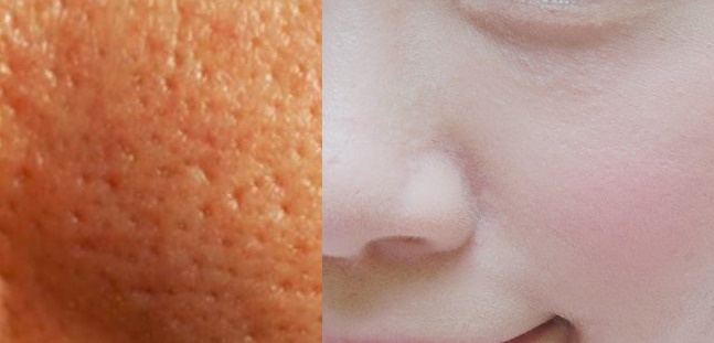 Xử lý tận gốc lỗ chân lông to, không lo tốn kém chỉ trong 2 bước!