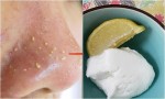 Thoa thứ này lên mũi, mụn cám sẽ tự biến mất mà không cần nặn