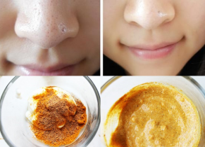 Đánh bại mụn đầu đen nhanh - rẻ - sạch chỉ trong 1 ngày với sữa chua