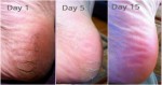 Bạn sẽ không bao giờ bị nứt gót chân chỉ bằng cách nghiền nát 10 viên aspirin trộn với cồn y tế đắp lên chân