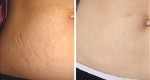 Chỉ cần dùng hỗn hợp này, rạn da nhiều đến mấy cũng khỏi ngay