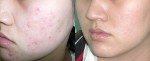 Sạch mụn trứng cá với công thức không mất tiền chỉ trong 1 đêm