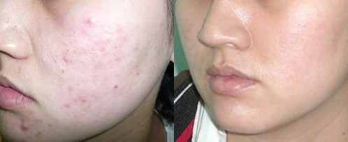 Sạch mụn trứng cá với công thức không mất tiền chỉ trong 1 đêm