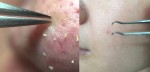 Bí kíp làm mụn tự trồi lên, dùng nhíp gắp ra dễ ẹc  cho mặt láng o