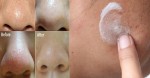 Mách bạn cách làm trị mụn, trắng da bằng kem đánh răng không bị dị ứng