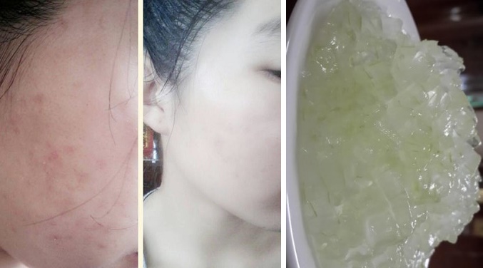 Nhờ mẹo nhỏ của mẹ tôi đã trị mụn thành công sau 2 tuần