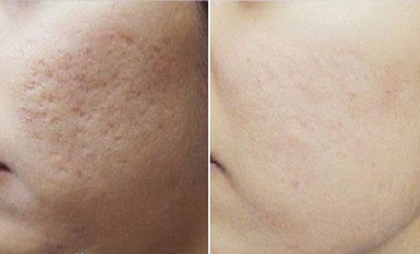 20 ngày trị sẹo lõm bằng rau má, hiệu quả bất ngờ bạn nên thử!
