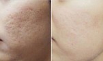20 ngày trị sẹo lõm bằng rau má, hiệu quả bất ngờ bạn nên thử!