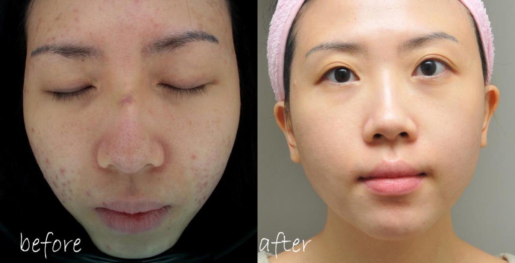 Chia sẻ bí quyết dưỡng trắng da trị mụn (đã được mình chuột bạch thành công sáng rỡ)