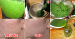 Da bị mụn nặng mấy cũng hết với 1 nắm lá rẻ tiền ai cũng biết