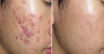 "Bóc sạch"mụn trứng cá không để lại vết thâm hiệu quả chỉ với nắm lá rau này