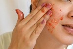 Mẹo cực hay tẩy tế bào chết cho da đang bị mụn trứng cá