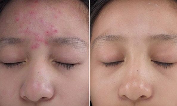 Trộn sữa rửa mặt với muối – cách giúp da sạch mụn, trắng mịn bất ngờ