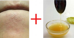 Công thức diệt tận gốc mụn đầu đen ở cằm và 2 cánh mũi