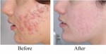 Trộn 3 thứ này với nhau, da sạch mụn, láng mịn chỉ sau 2 phút
