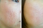 Mách các nàng 3 công thức trị mặt rỗ, sẹo lõm đã được nghiên cứu