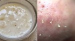 Thoa thứ này lên mũi 2 phút, mụn đầu đen tự biến mất không cần nặn