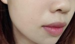 Em đã trị thâm môi trên 10 năm thành công trong 1 tháng