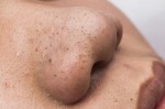 Có 3 cách này, trị mụn đầu đen chưa bao giờ dễ dàng đến thế