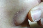 Mụn cám trắng xóa trên mặt cũng phải lặn mất tăm chỉ sau 1 tuần với một nhánh này