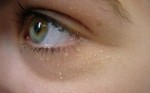Không cần bắn tia laser mụn thịt dễ dàng biến mất sau 7 ngày, quá đơn giản nè các chị!