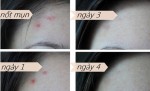 Dùng cách này, mụn sẽ xẹp ngay sau đúng 4 ngày