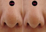 Đây là cách dễ và đơn giản nhất để trục xuất vĩnh viễn mụn đầu đen trên da