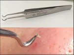 Chiếc nhíp gắp mụn đầu đen khiến phái nữ sôi sục gần đây