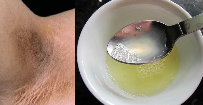 Nách thâm đen và sần sùi như da cóc cũng mịn màng trở lại bằng hỗn hợp chưa đến 5k này