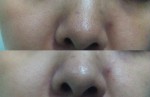 Bí quyết trị mụn đầu đen, se lỗ chân lông to (em đã thành công & có hình ạ)