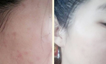 Kinh nghiệm trị mụn, thâm mụn dứt điểm chỉ trong 2 tuần