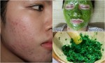 Sẹo lõm mờ đi trông thấy chỉ với 2 ngàn đồng rau má