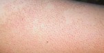 Sạch hẳn viêm nang chân lông tại nhà sau 2 tuần, an toàn không kích ứng
