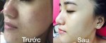 Thâm mụn, sẹo mụn - áp dụng ngay công thức 7 ngày này, hiệu quả không thua gì spa