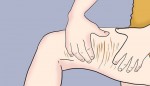 18 tuổi đã bị rạn da, liệu có cách nào để chữa hết?