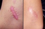 Trị sẹo lồi lâu năm vĩnh viễn chỉ nhờ 1 nắm ngải cứu