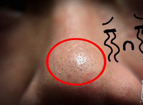 Tận diệt sạch mụn đầu đen chỉ với 3 loại mặt nạ tự chế sau