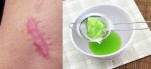Là phẳng sẹo lồi, lấp đầy sẹo lõm với nửa quả đu đủ xanh – nhanh và hiệu quả đến khó tin