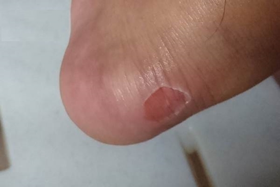 3 mẹo đi giày không bao giờ bị rộp chân mà chị em nào cũng biết