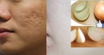 “Thần dược” trị sẹo lồi lâu năm giúp bạn "lột xác" an toàn: 10 người thử thành công cả 10