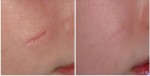Sẹo to cỡ nào, lâu năm đến đâu, cứ bôi hỗn hợp này lên là hết ngay