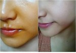 Thổi bay nám - tàn nhang nhờ tinh dầu gấc tự chế tại nhà