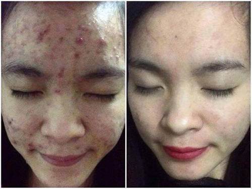 Rửa mặt với nước muối, mụn chi chít đến đâu cũng phải khỏi ngay tức khắc