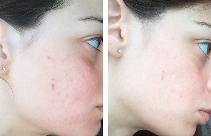 Da MỤN + NHẠY CẢM đừng bỏ qua công thức toner không cồn này!